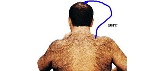 مزایای کاشت مو به روش بی اچ تی